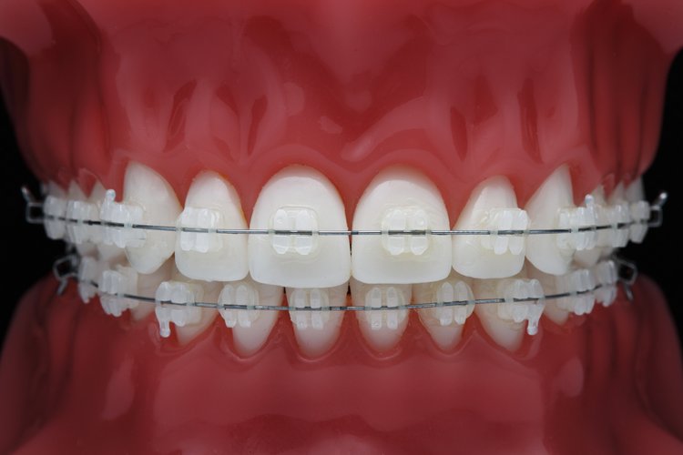 excellent dental photography of a model of jaws with braces in good lighting