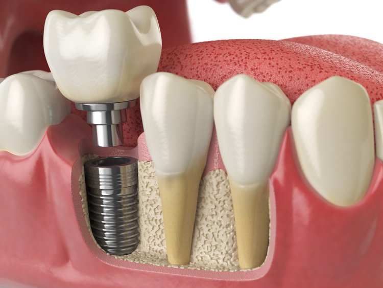 Dental Implants Birmingham